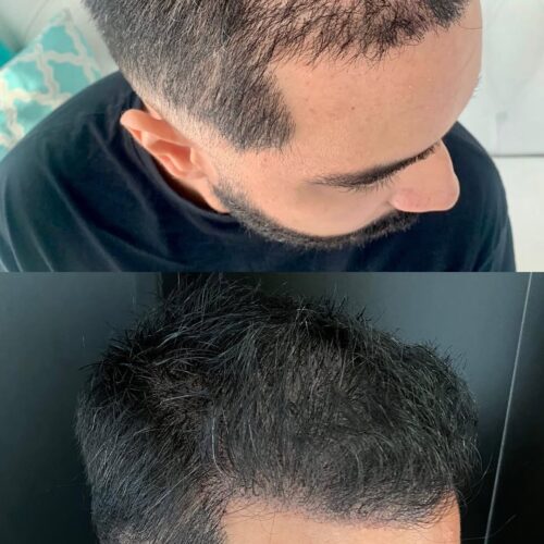 Micropigmentação Capilar 27 snaplytics.io_instagram_thumbnail (6)